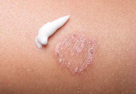 Treating ringworm with a topical cream