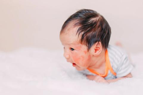 Infant with eczema rash on face