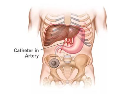 17-DDI-152-Hepatic-Artery-Chemo-CQD-4