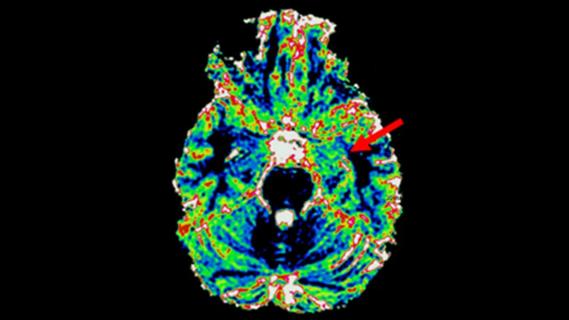 colorful brain scan with a red arrow pointing to a spot on right side