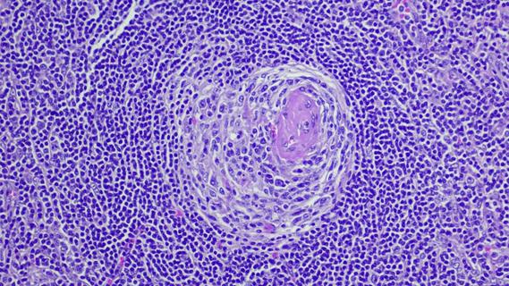 cells with idiopathic multicentric Castleman Disease