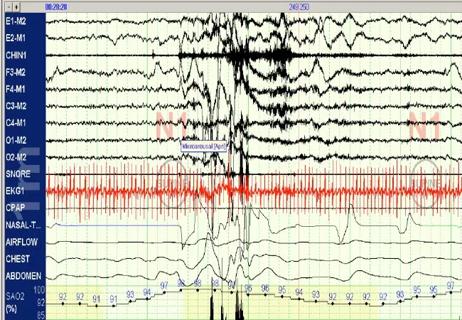 polysomnogram showing obstructive sleep apnea