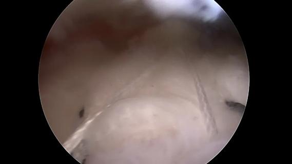 Augmented rotator cuff repair