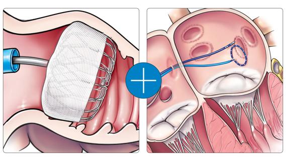 illustrations of two heart procedures connected with a plus sign