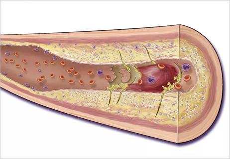 Coronary artery that is beset by a good deal of atherosclerosis