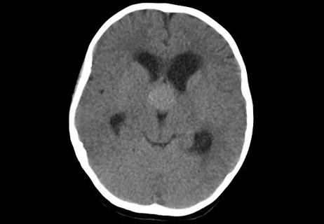 20-NEU-1897062_brain-CT-in-child-with-papilledema