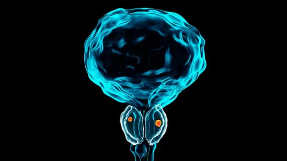 Prostate cancer