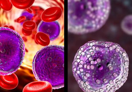 Illustration of Leukemia cells vs Lymphomia cancer cells