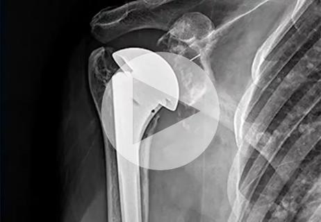 Going All Arthroscopic for Augmentation of Rotator Cuff Repairs