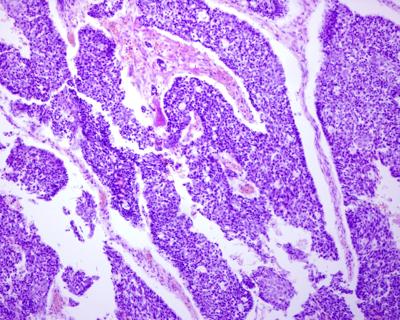 bladder cancer pathology view