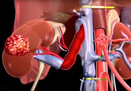 650&#215;450-Thrombectomy-Screen-Shot-2017-06-05-at-11.42.30-AM_New Header Image_16-URL-859