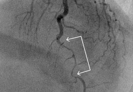 22-HVI-2713173_spontaneous-coronary-artery-dissection_650x450