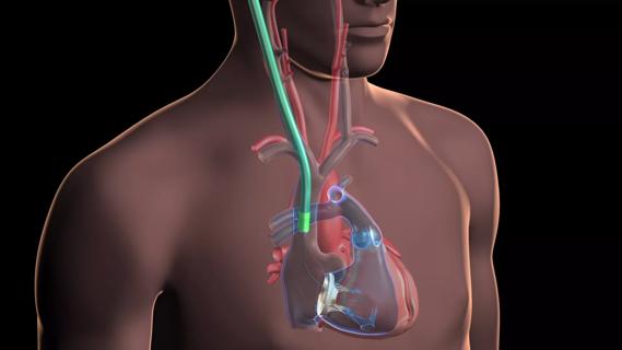 Cleveland-Clinic-Heart-Valve