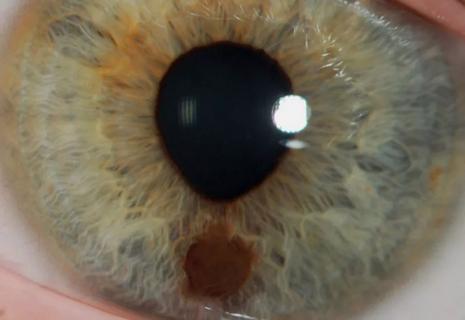 Eye-Melanoma