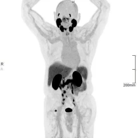 PSMA PET CT