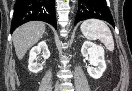 650&#215;450-Renal-Cell-Carcinoma