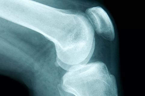 X-ray of a knee