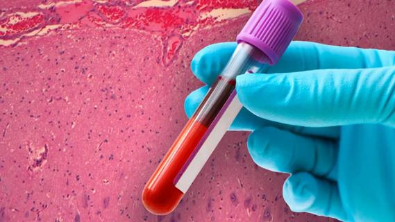 gloved hand holding blood vial with neuropathology slide in background