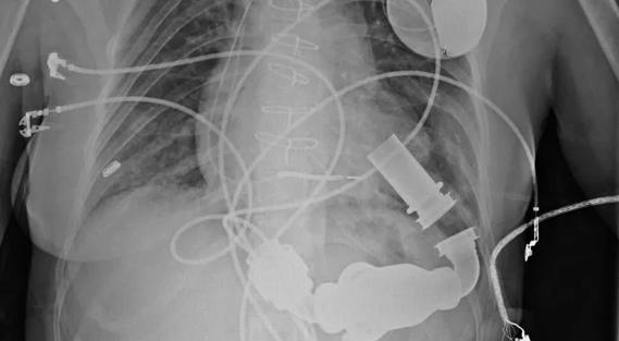 LVAD_690x380