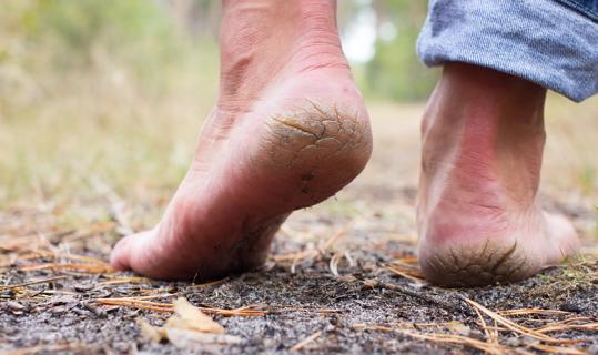 Feet with cracked heels, walking barefoot outside