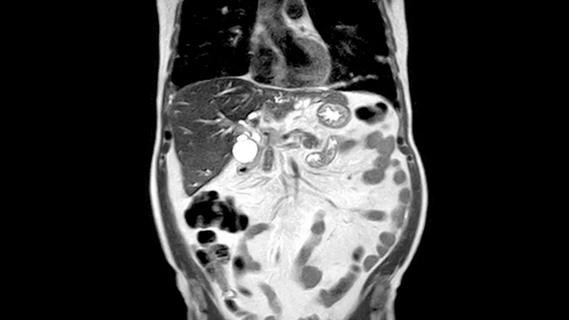 scan showing cholangiocarcinoma