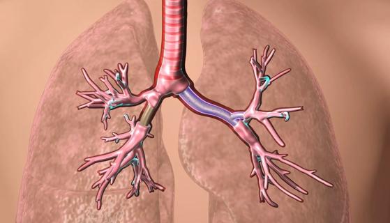 lung stent video Capture