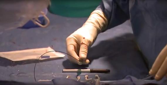 stent ccns story