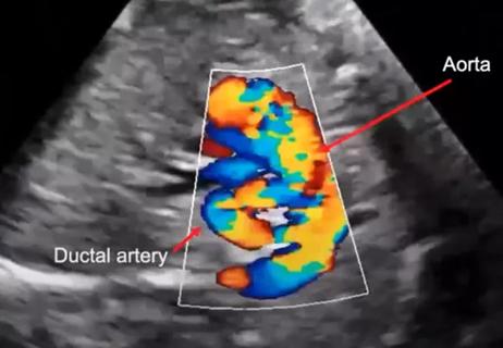 23-CHP-3814908 CQD Rao &#8211; Fetal Echocardiography