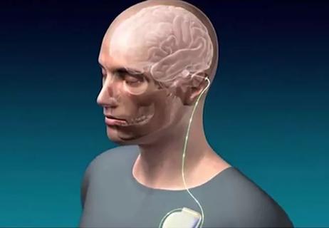 22-NEU-2922372-deep-brain-stimulation_650x450