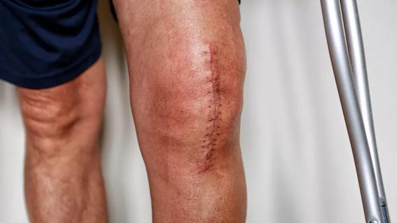 Swollen knee with scar