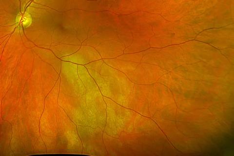 Eye exam