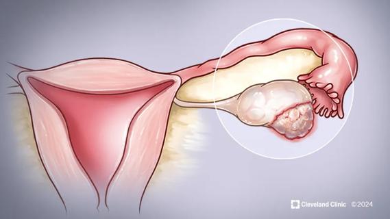 Medical illustration of an ovarian tumor