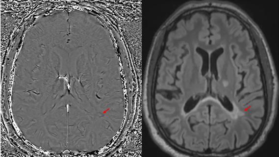 two brain MRIs with red arrows indicating spots of interest