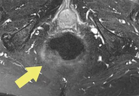 Skene&#8217;s Gland Malignancy: A Case Report and Systematic Review