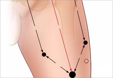 650&#215;450-Inguinal-lymph-nodes_robotic-ports_20-URL-1830311