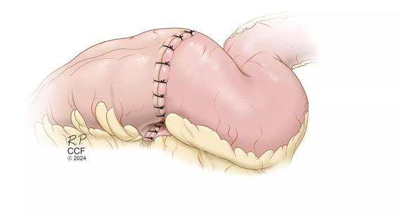 Medical illustration of Ileocolic Resection