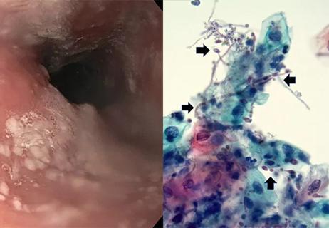 esophageal plaques