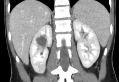 650&#215;450-Diagnostic-Dilemma-Renal-Cancer