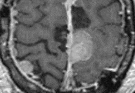 brain scan showing meningioma