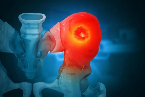 Lesion in acetabulum
