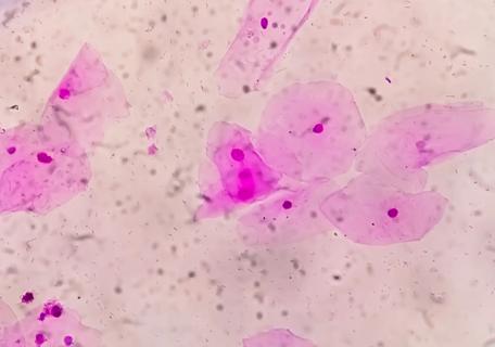 Slide image of bacterial vaginosis