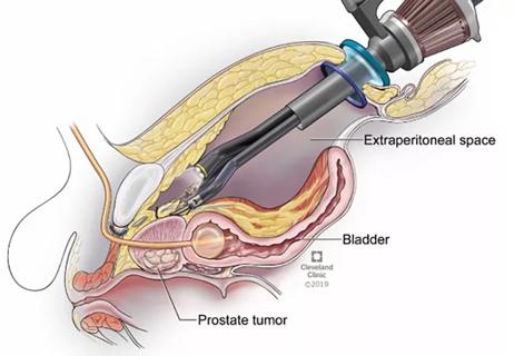 Medical illustration prostate tumor | Cleveland Clinic