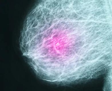 Breast cancer