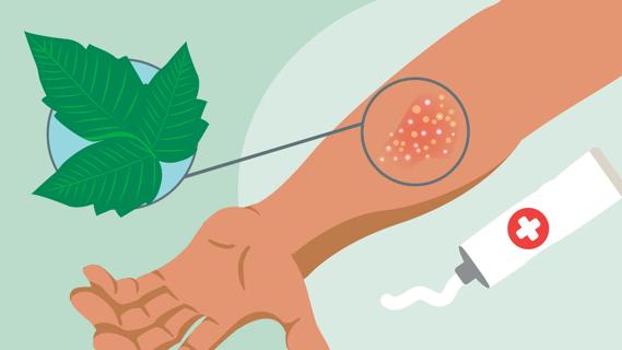 Arm with poison ivy rash, with a poison ivy leaf and tube of medicinal cream