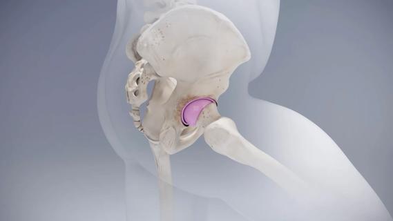 Ceramic hip resurfacing implant