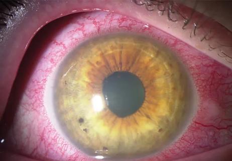 Redness in the eye caused by anterior chamber inflammation