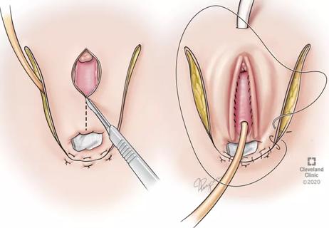 vaginoplasty