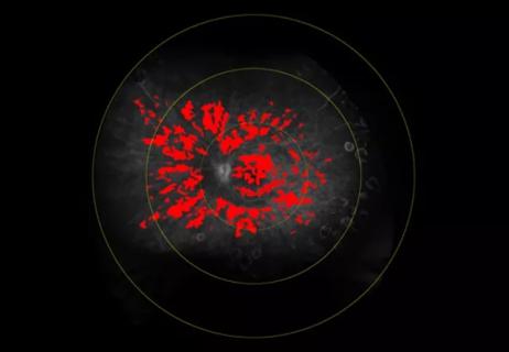 Retinal leakage on fluorescein angiography