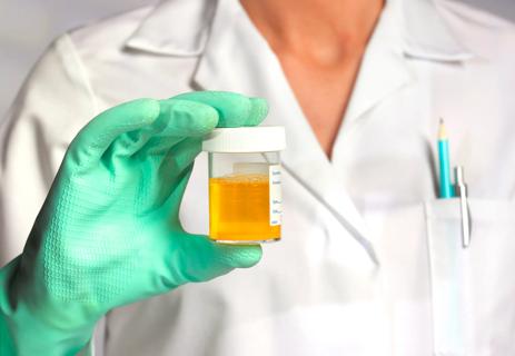 Clinician holding urine sample in gloved hand