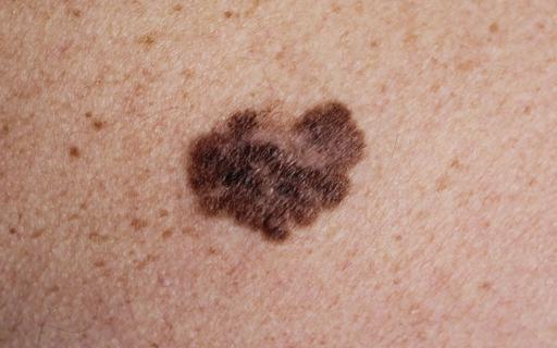 melanoma